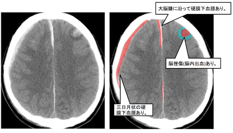 急性硬膜下血腫